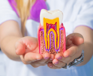 Need a Crown After a Root Canal