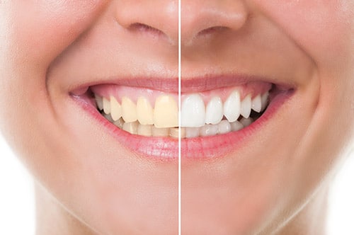 Teeth Whitening in Frisco