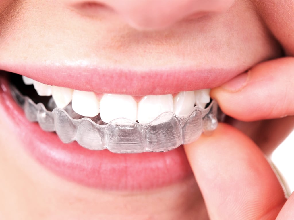 Ask Your Frisco Dentist: What’s the difference between Invisalign and Metal Braces?