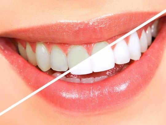 Bleaching of Non-vital Discolored Teeth: Keys of Success - Dental News