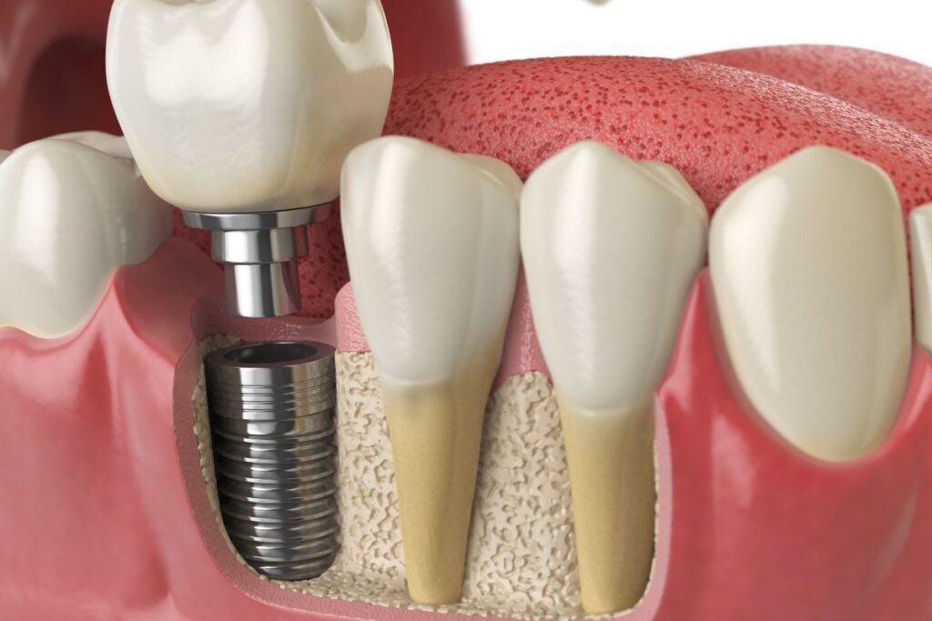 Tooth Loss Treatment with Dental Implants
