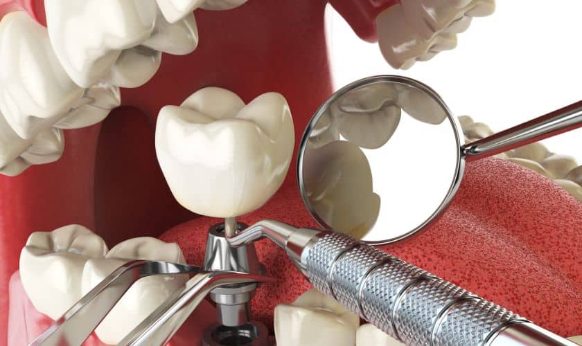Implant Dentistry in Frisco- Heritage Family Dentistry
