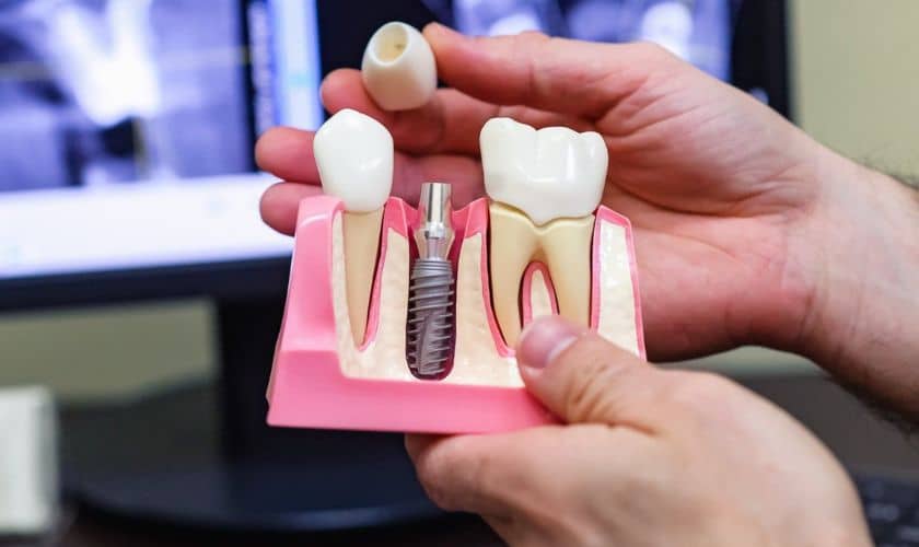 Dental Implants Frisco