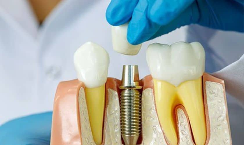 Dental Implants in Frisco