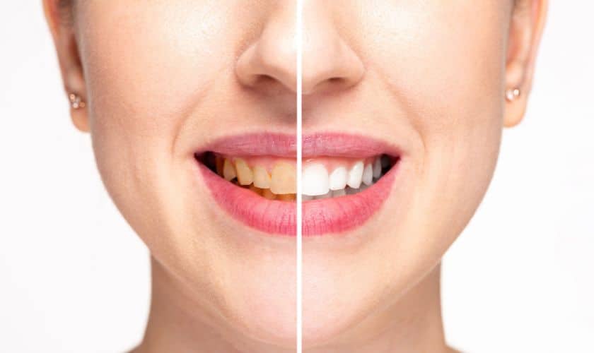 Teeth Whitening in Frisco