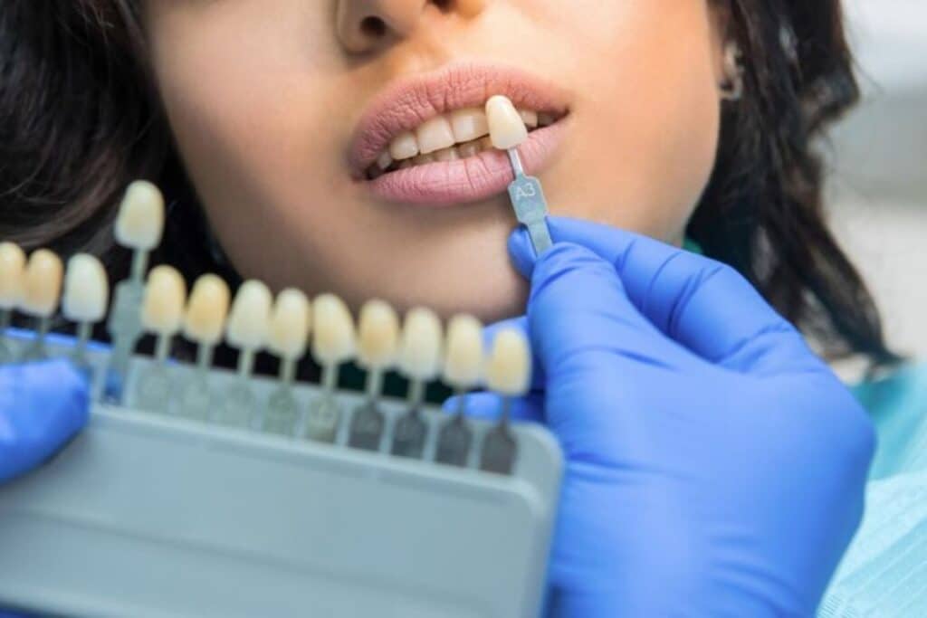 Dental Veneers Frisco