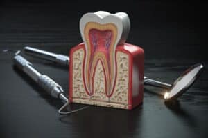the Right Endodontist for Your Root Canal