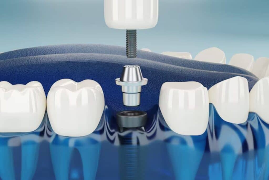 Dental Implants in Frisco
