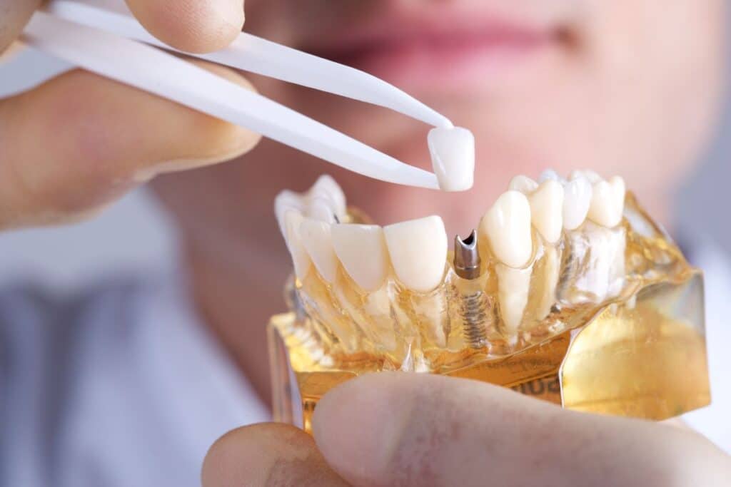 Dental Implants in Frisco