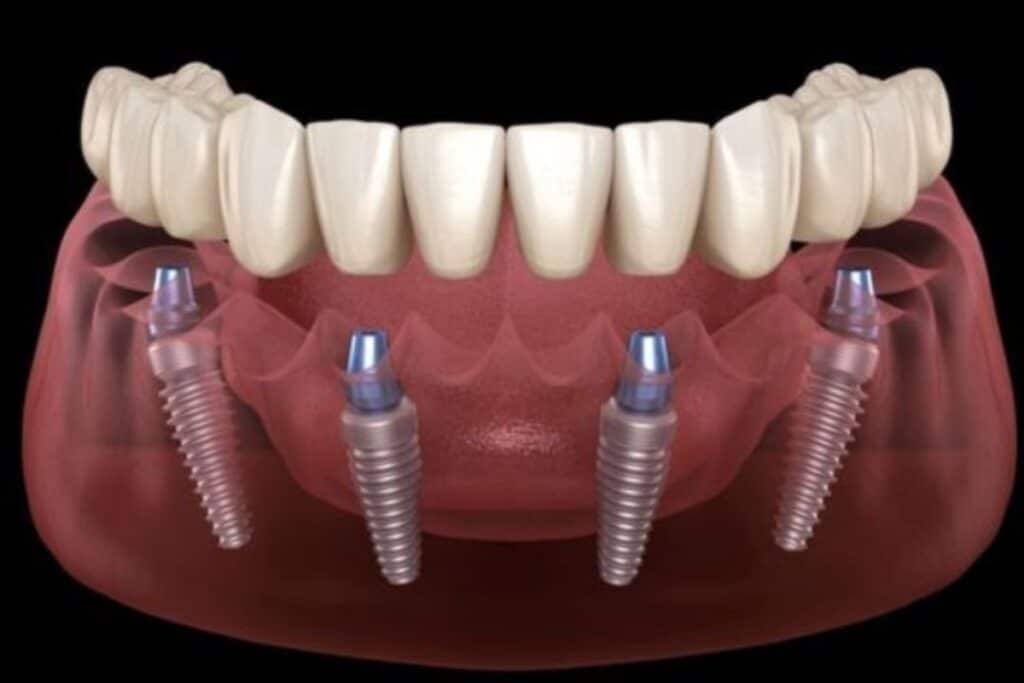 All-on-4 Implants Frisco