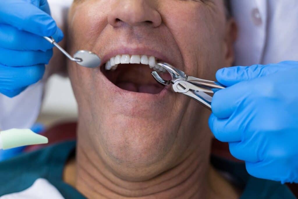 Tooth Extraction Frisco