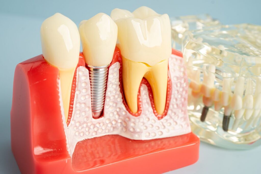 Implant Dentist Frisco
