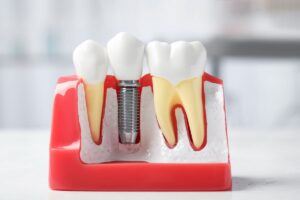 Dental Implants Frisco