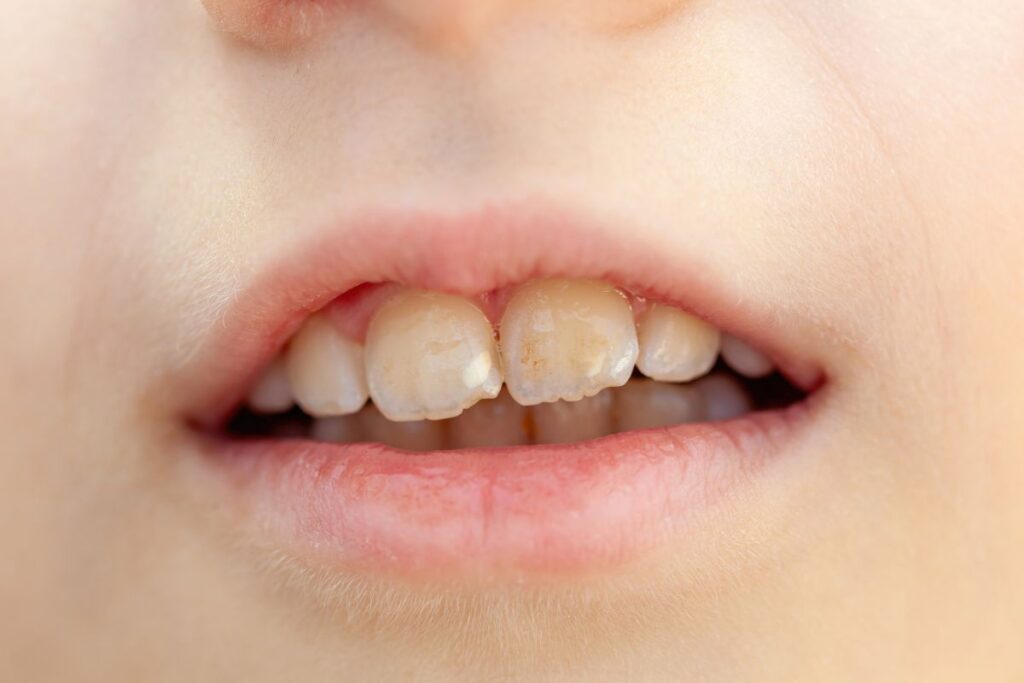 White Marks on Teeth