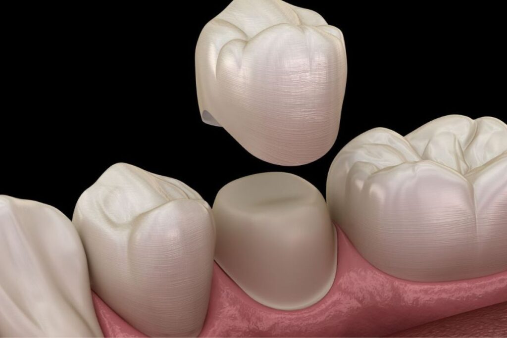 Dental crown on damaged tooth