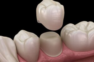 Dental crown on damaged tooth