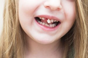 Knocked-Out tooth treatment