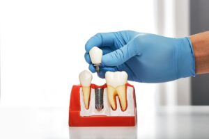 dental implant model close-up