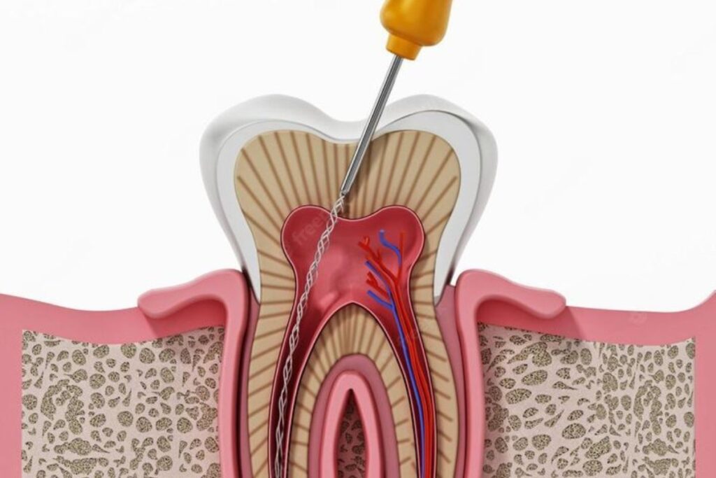Root Canal Treatment for Cracked Tooth